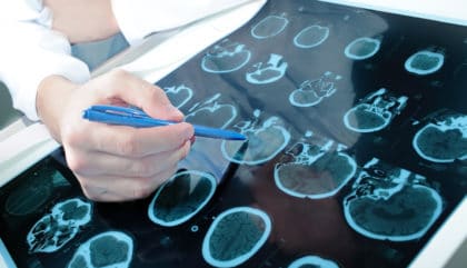 massachusetts hospital to study cbd for alzheimer's